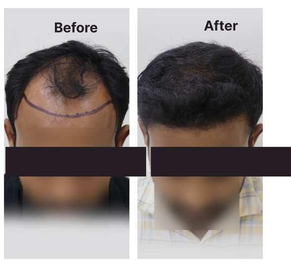 Hair Transplant result KOQ10